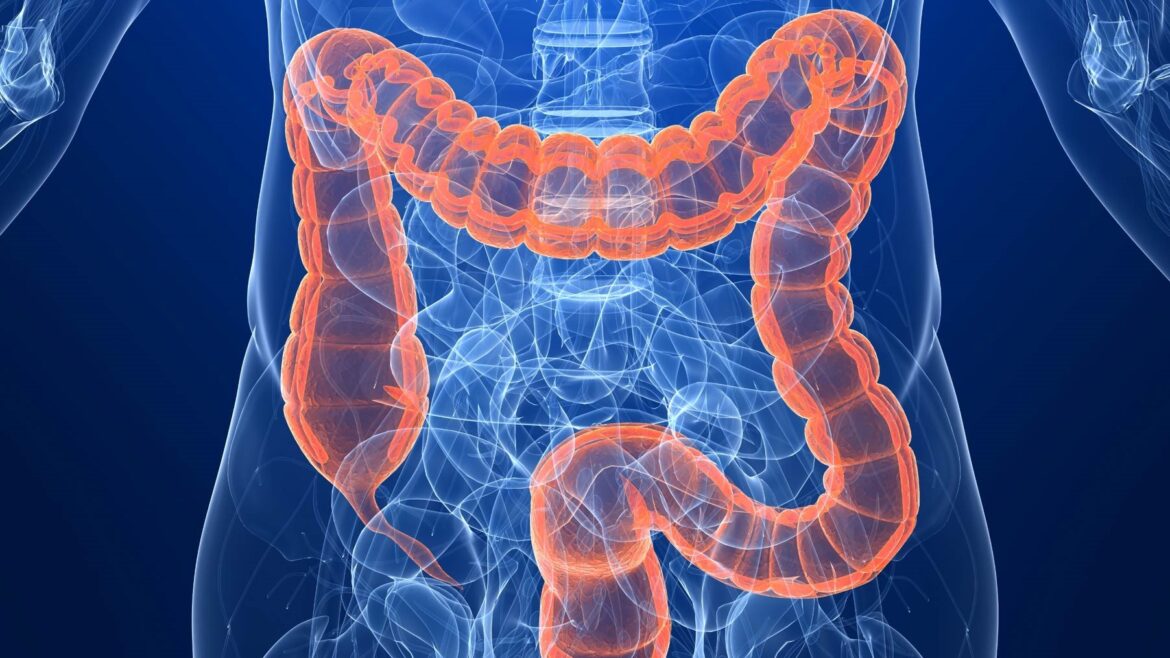 Los nuevos síntomas que se relacionan con el cáncer de colon