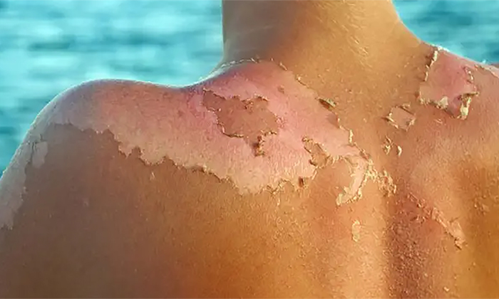Urgen a protegerse del sol para evitar quemaduras y cáncer de piel