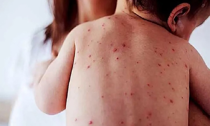 Duplica Sonora casos de sarampión