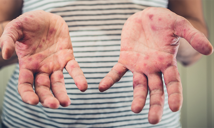 Siguen en aumento casos de sarampión en Sonora