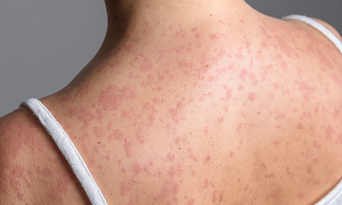 Sigue avance del sarampión