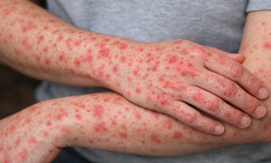 Sonora acumula 322 casos de sarampión en el año